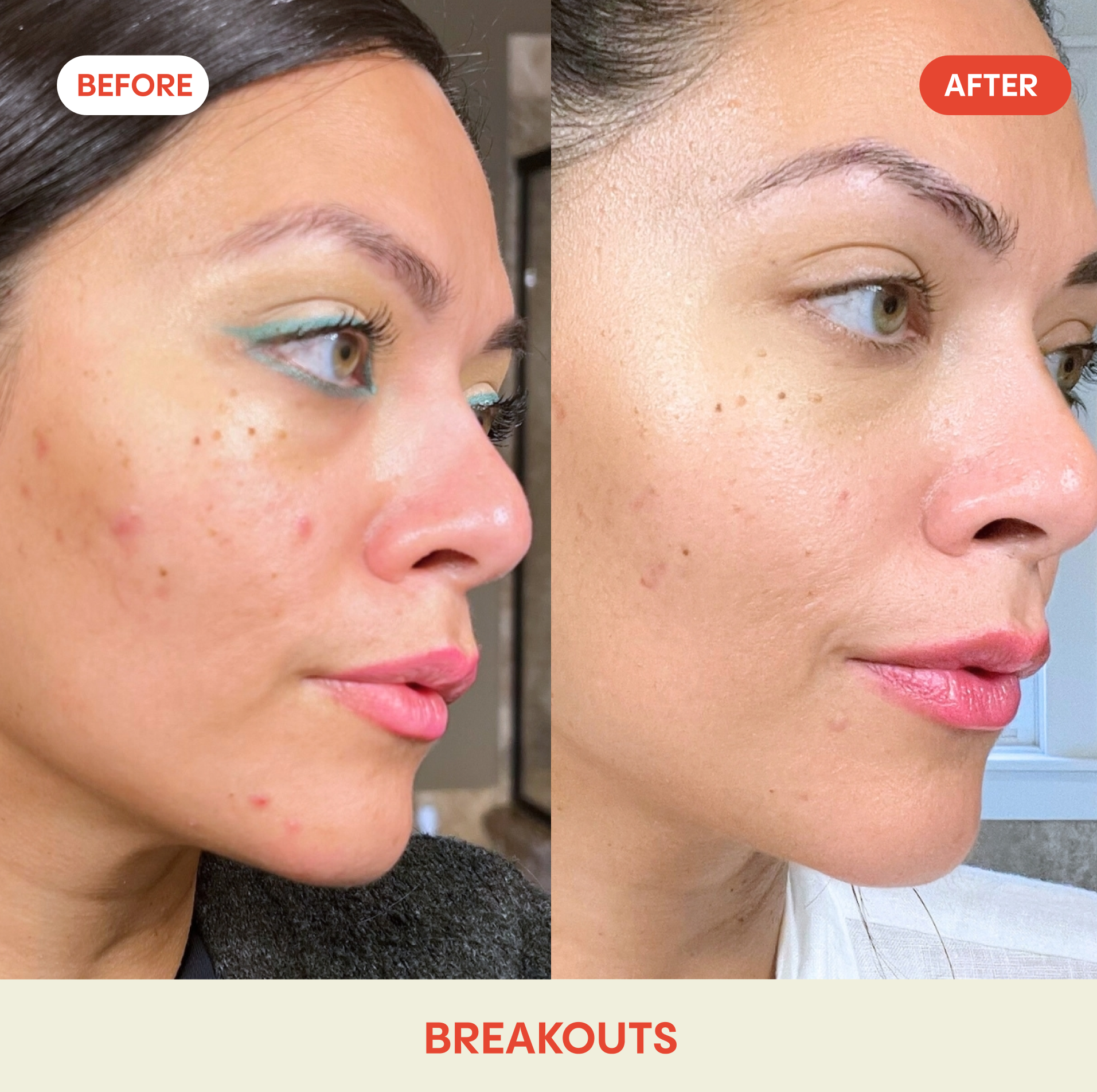 Hypochlorous Acid Facial Spray for Acne, Eczema, Rosacea: Standard