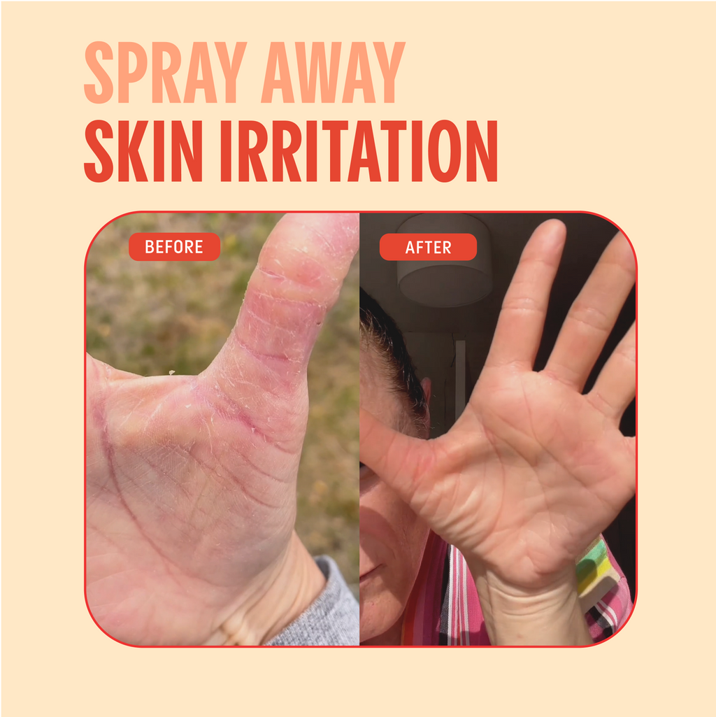 Hypochlorous Acid Facial Spray for Acne, Eczema, Rosacea: Standard