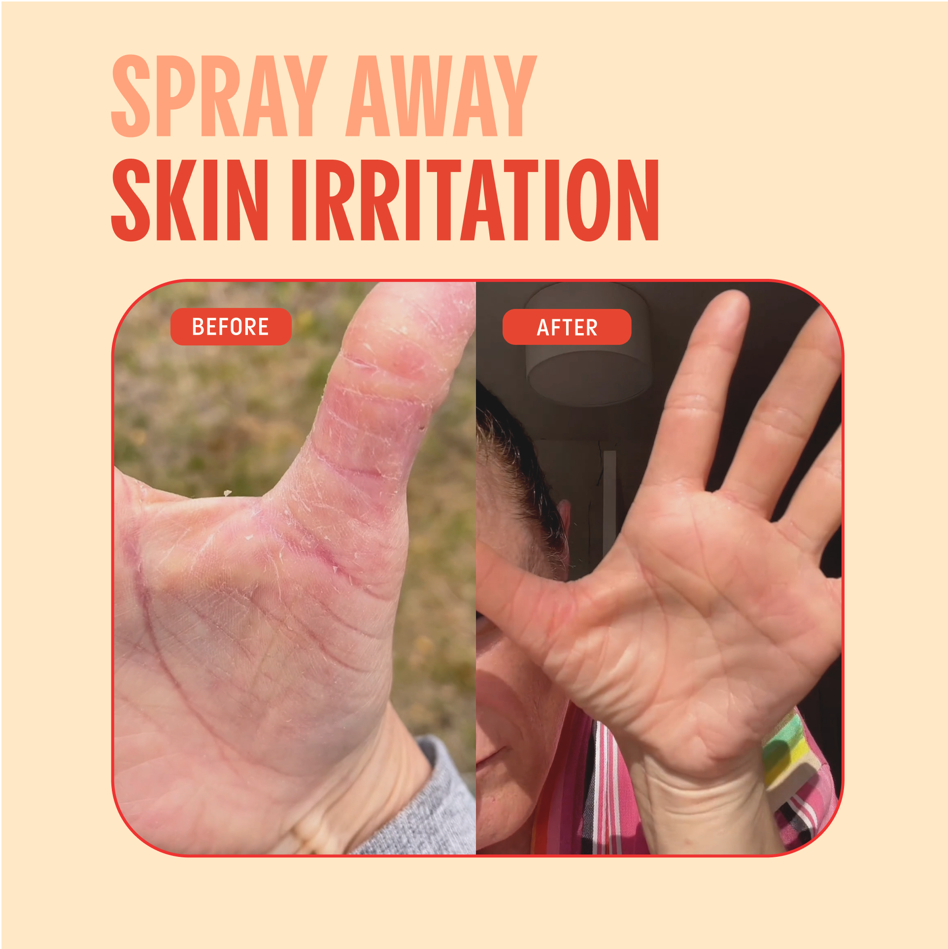 Hypochlorous Acid Facial Spray for Acne, Eczema, Rosacea: Standard