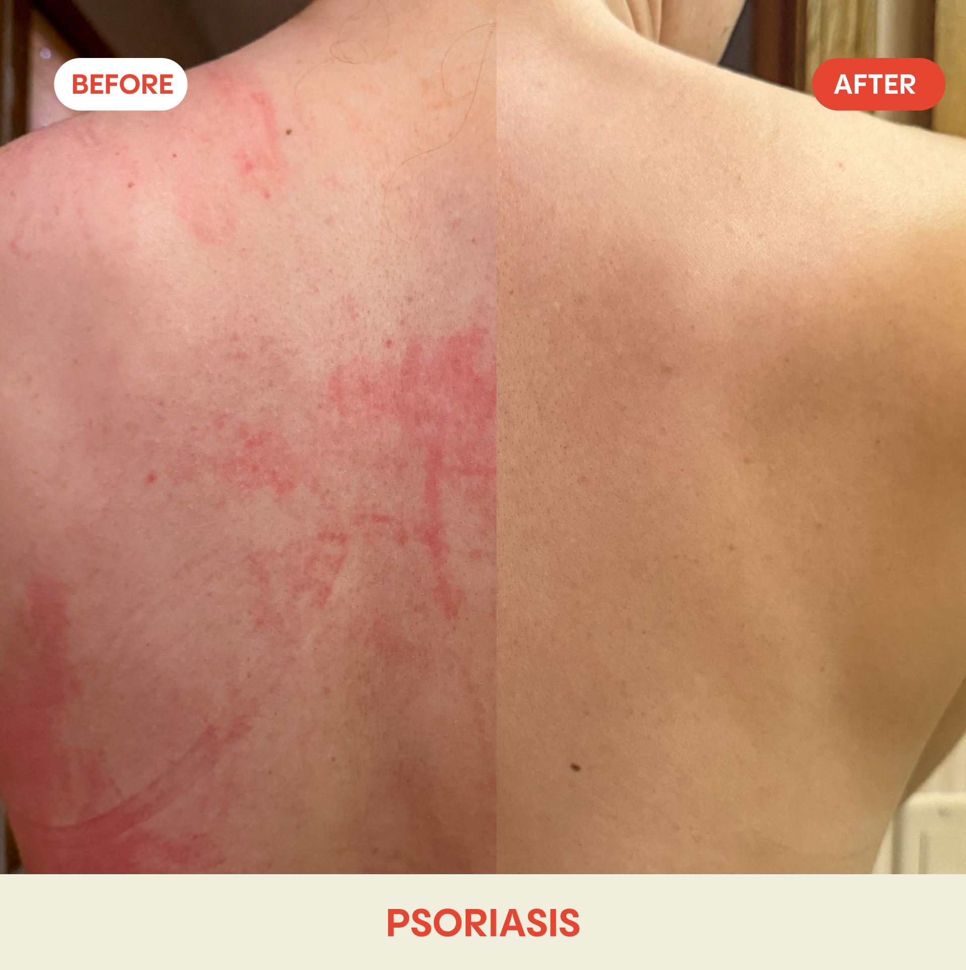 Hypochlorous Acid Facial Spray for Acne, Eczema, Rosacea: Standard