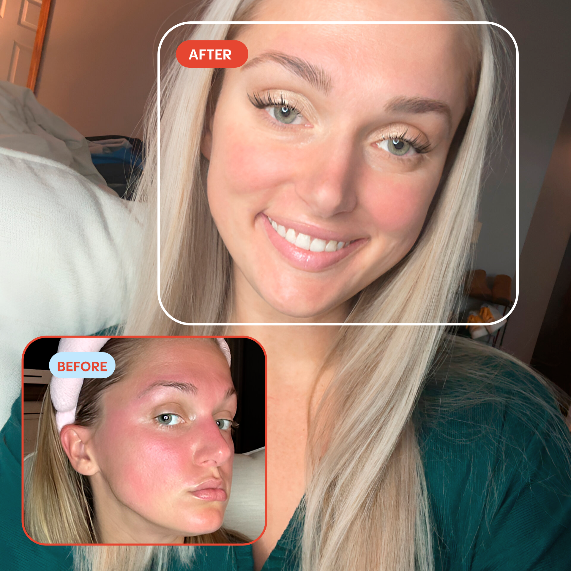 Hypochlorous Acid Facial Spray for Acne, Eczema, Rosacea: Standard